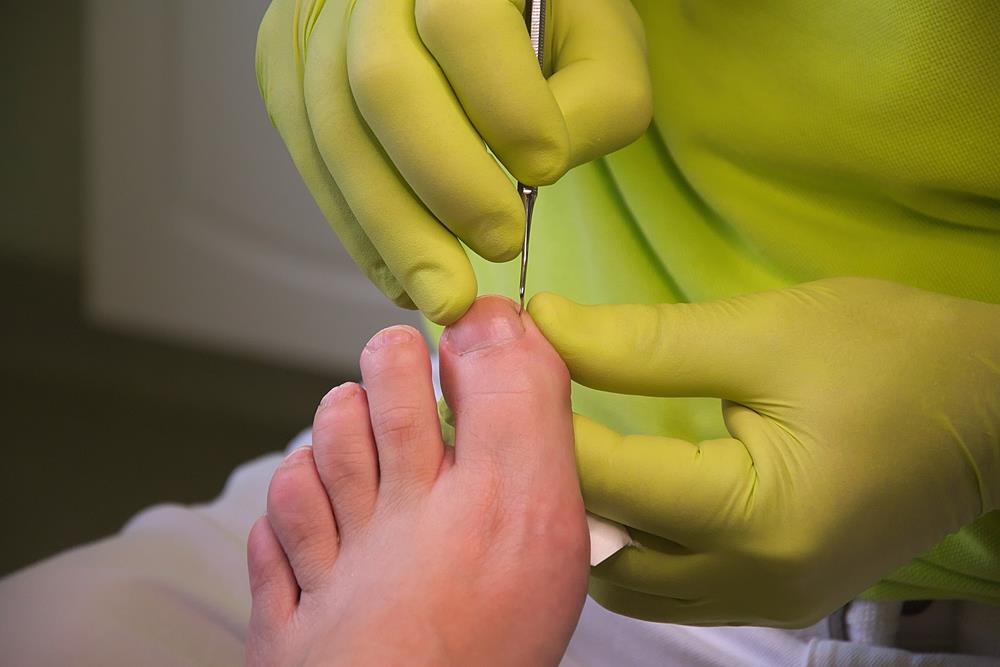 Ingrown Toenails 