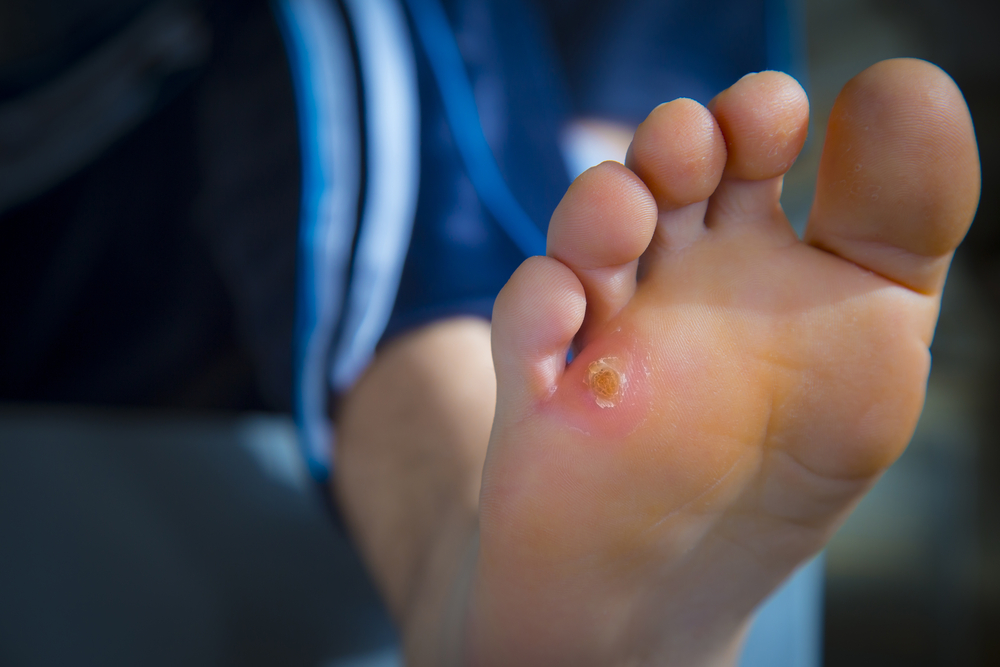 Wound Care 